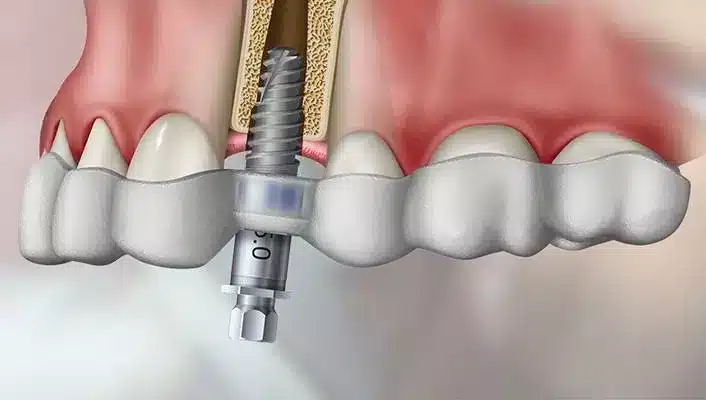 3D Guided Dental Implant Procedure