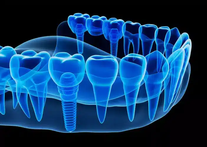 3D Guided Dental Implants