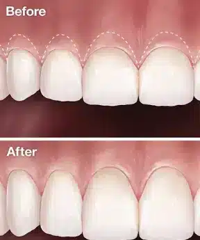 Gum-Surgery-Types-and-What-to-expect